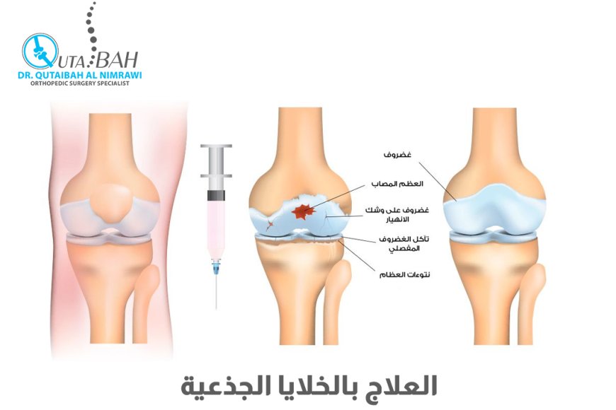 العلاج بالخلايا الجذعية