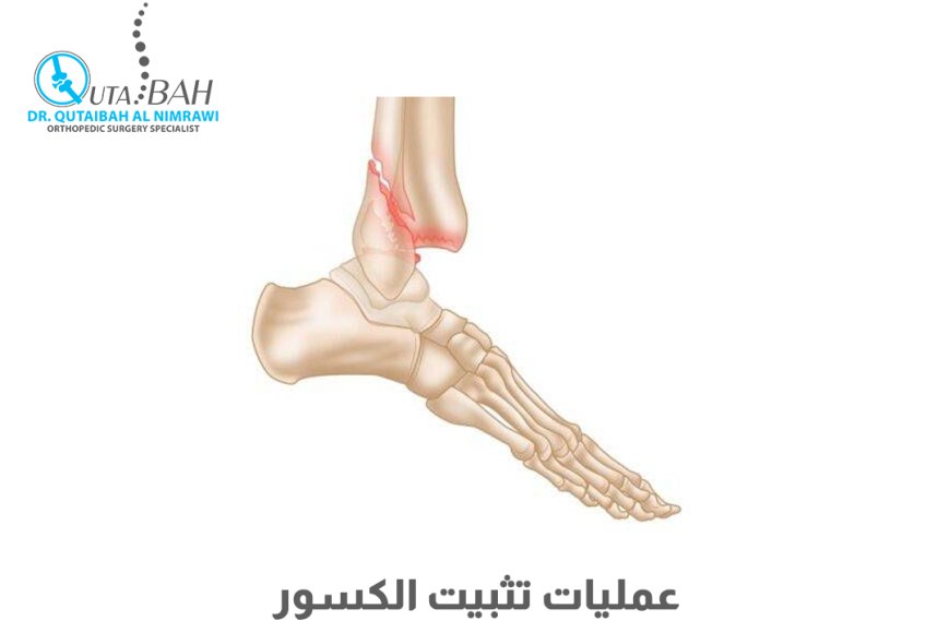 كيف تُعالَج الكسور؟