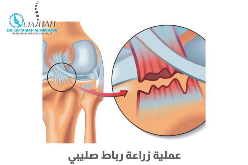 عملية زراعة الرباط الصليبي الأمامي