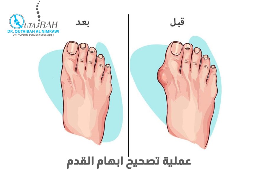 عملية تصحيح انحراف ابهام القدم