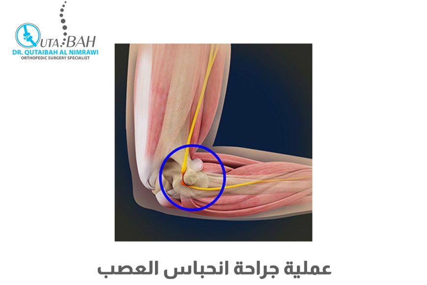 ما هي جراحة علاج انحباس العصب؟