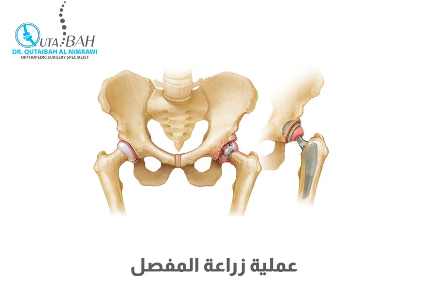 عملية تبديل مفصل الورك