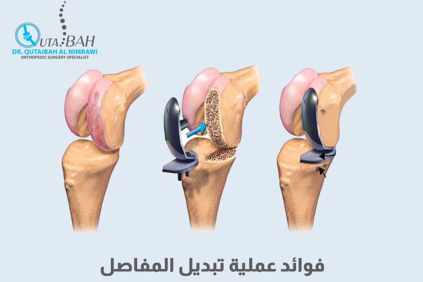 ما هي فوائد جراحة استبدال المفصل؟