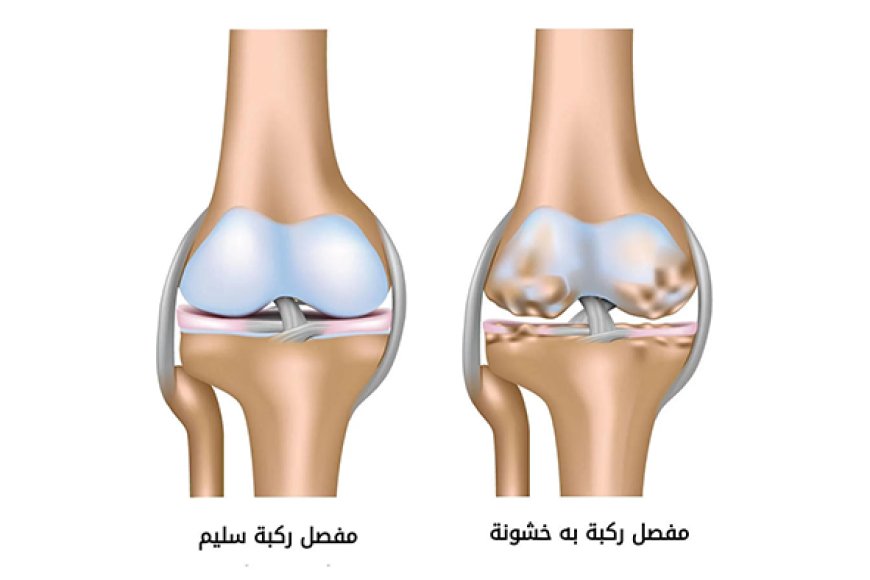 خشونة الركبة