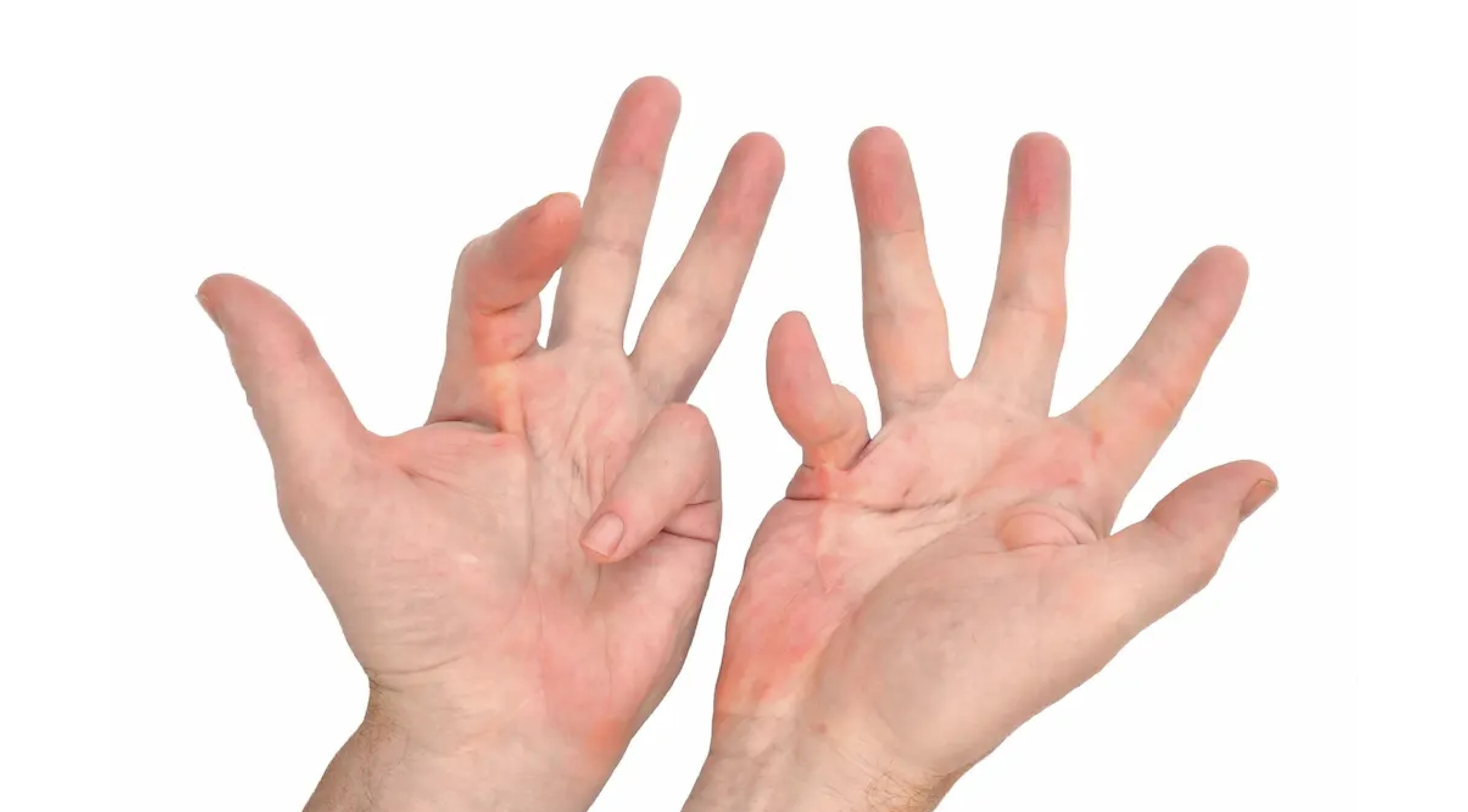 مرض دوبوترين